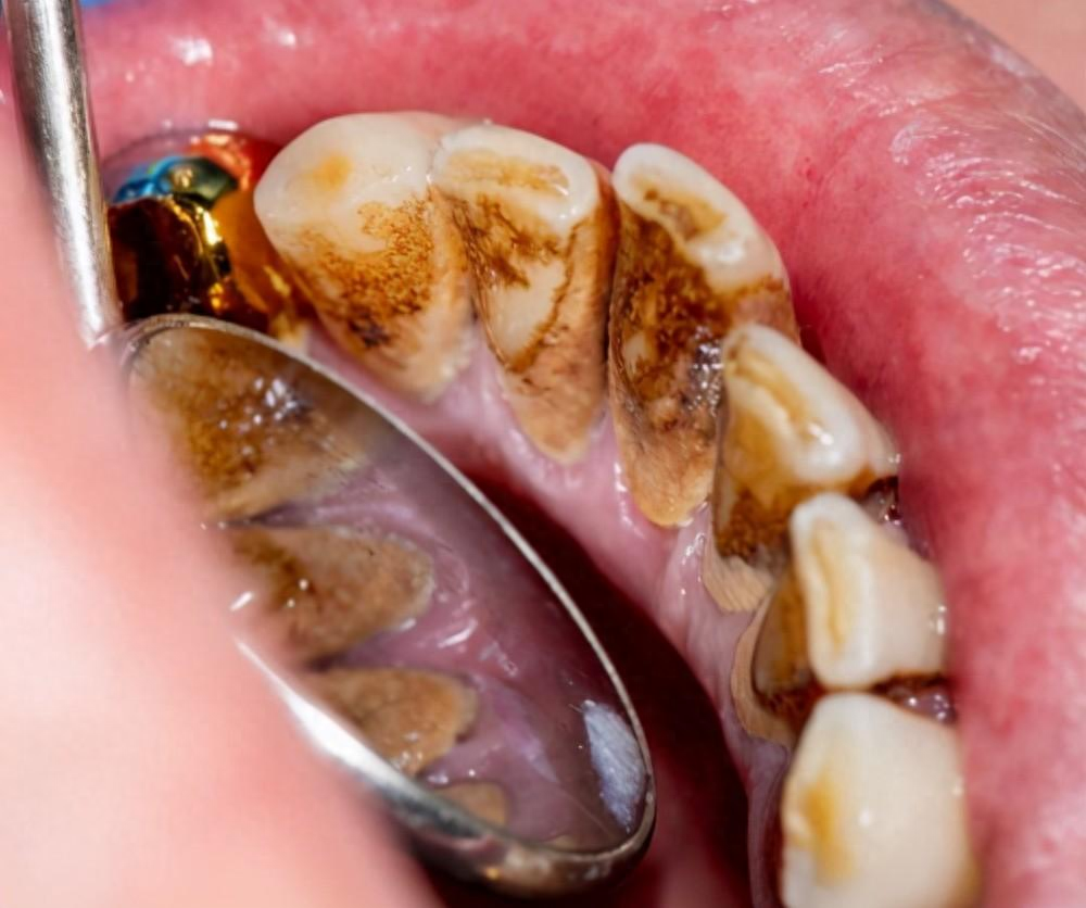相信不少人都知道，牙结石堆积过多会引发口臭、牙龈出血、牙龈萎缩等各种牙齿疾病。为了解决这个问题，我和我的团队选取了三款国货牙粉进行测评，由于我的牙结石比较严重，所