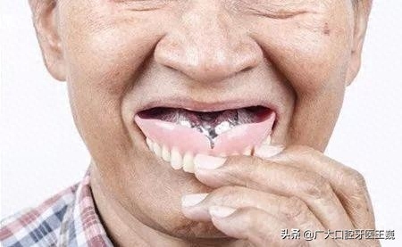 现在越来越多的老年人在缺牙之后会戴上活动假牙。由于长时间的佩戴，嘴巴里总是有一股味道！比不戴假牙“口气”更大！如何避免这些情况的出现呢？其实只要做好以下几点，就能