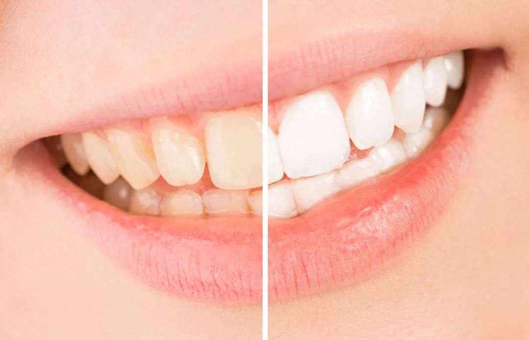 牙齿漂白有哪些方法