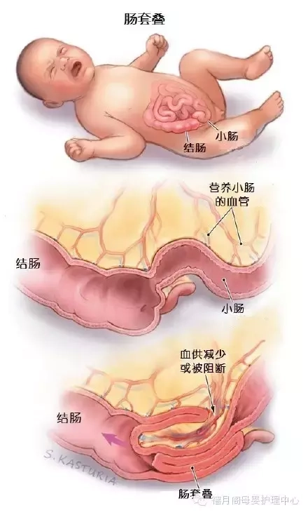 你知道吗？肠套叠是指一段肠管套入与其相连的肠腔内，并导致肠内容物通过障碍。肠套叠占肠梗阻的15%～20%。有原发性和继发性两类。原发性肠套叠多发生于婴幼儿，继发性肠套叠则