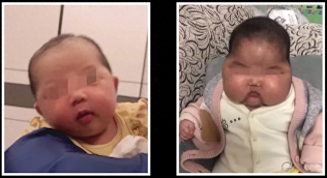 5个月大的婴儿，外表出现了和年龄完全不相仿的肥胖。原来，婴儿的爸妈购买了一款儿童护肤面霜，孩子使用后出现了发育迟缓、脸部肿大等情况。左：使用前；右：使用后丨图源网络